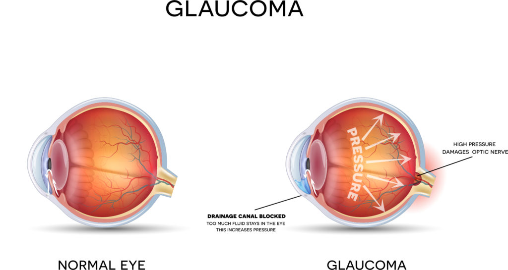 How is Glaucoma resolved